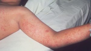 Read more about the article Houston Health Department: Unvaccinated infant diagnosed with measles after international travel – KENS5.com