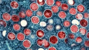 Read more about the article Monkeypox in the United States and Around the World: Current Situation – Centers for Disease Control and Prevention | CDC (.gov)